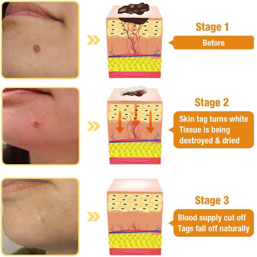 Bee Venom Wart and Skin Tag Remover Spray